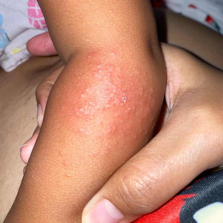 Butlig butlig sa skin ni baby