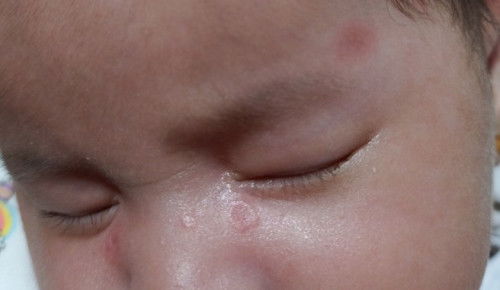 Insect bite ? Heat rash ? Baby Acne ?