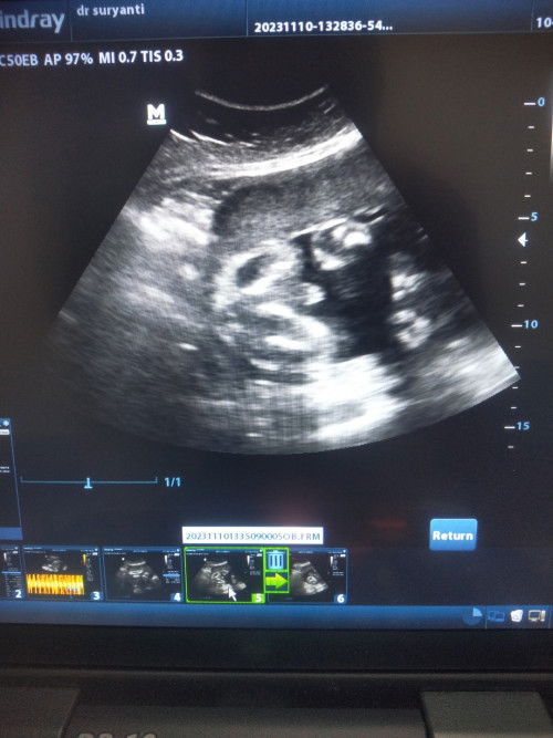 Hasil usg 30 weeks