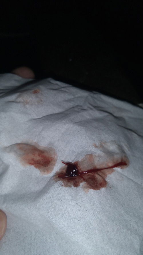 Gumpalan darah dari gigi