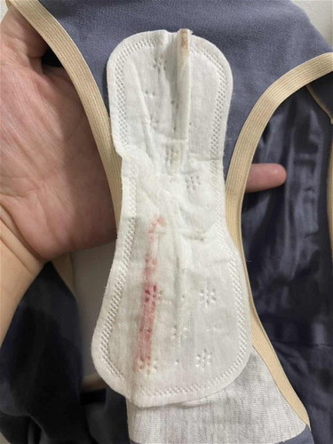 Rectal bleeding due to hemorrhoids
