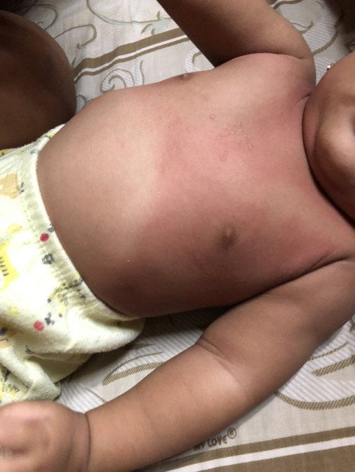 Sebadan merah dan bentol