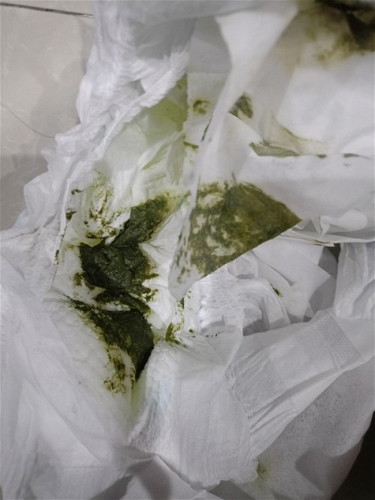 Dark Green Poop with Foul Smell