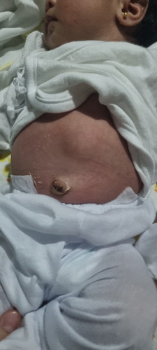 Meron po ba sainyo ng kagaya sa baby ko na maliit na bukol sa tyan after birth?