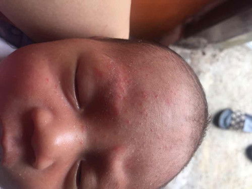 Wajah bayi merah merah