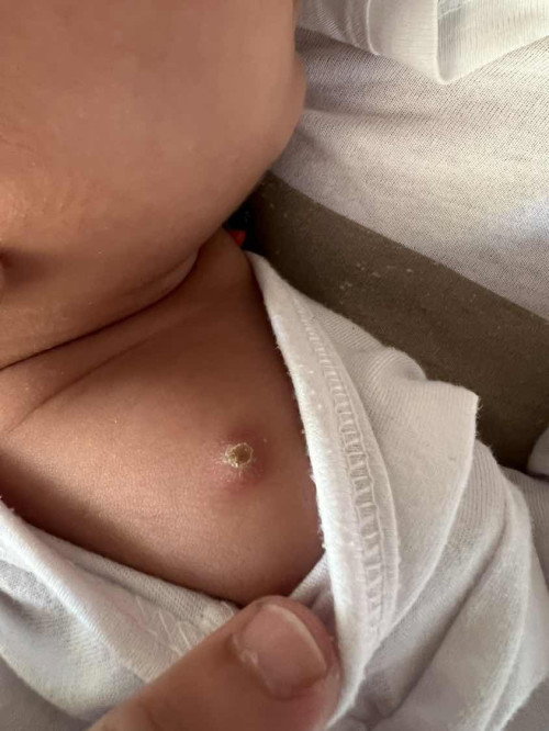 Bakuna ng baby, normal ba?