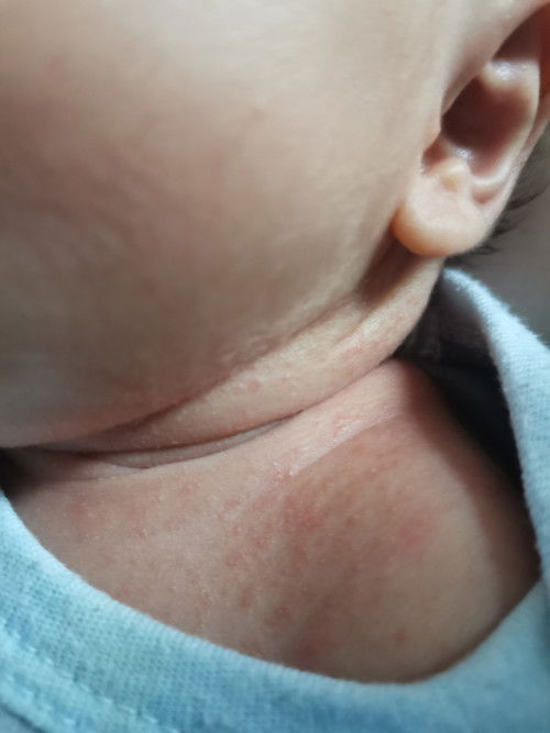 ผื่นตามคางและซอกคอ