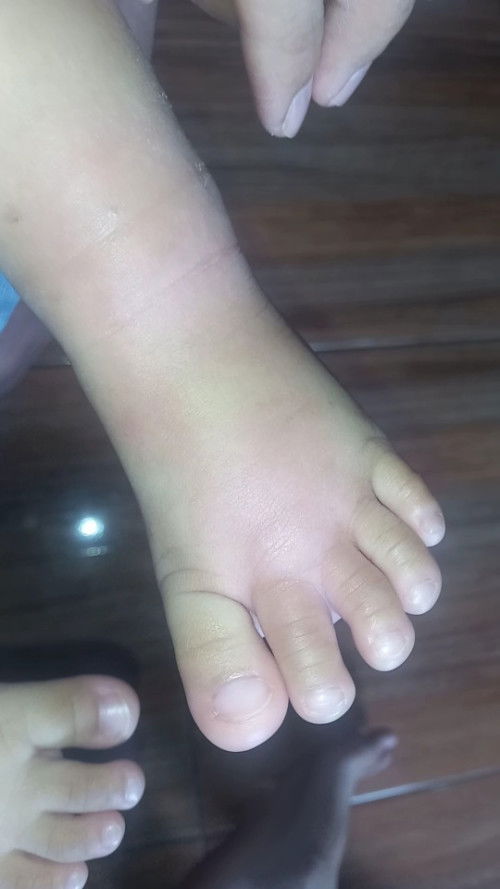 Insects bite?
Baka po kay nakakaalam kung skeeter syndrome ba ito o hndi.
At ano po gamot?