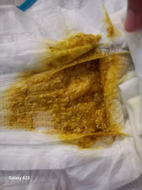 Bé e 3m19d bú sữa công thức vừa bú sữa xong là đi ngoài phân lỏng có hột li ti trong phân  là bị s ạ