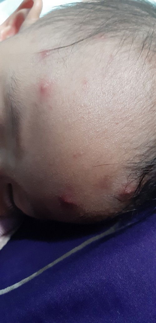 Bentol merah di dahi