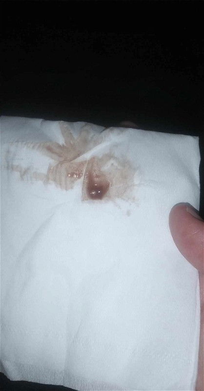 หมอตรวจปากมดลูกแล้วมีเลือดออก