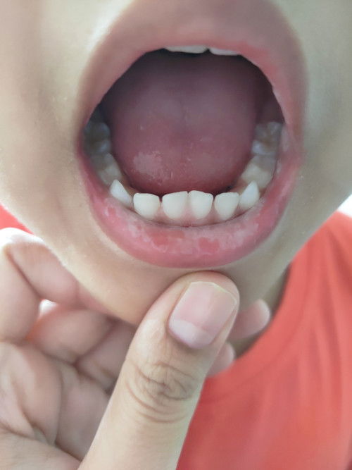 Timbul tompok2 putih di dinding pipi dan bibir