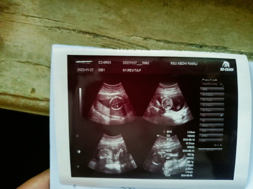 Usg Minggu ke 18
Wajar nggak sih kalau kepala baby utun masih di atas??