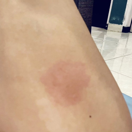 Kulit ruam merah gatal