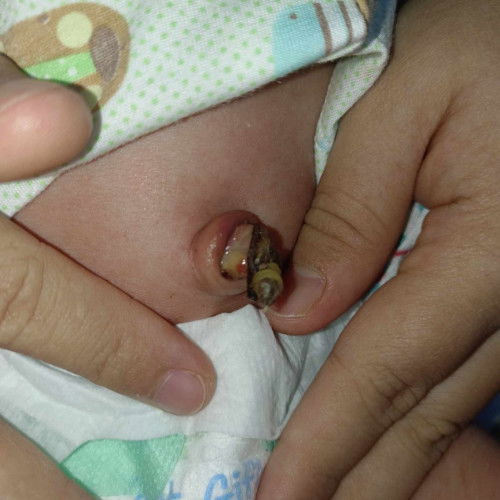 สะดือเป็นแบบนี้ควรไปหาหมอไหมคะ