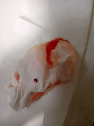 Keluar gumpalan seperti hati ayam waktu hamil