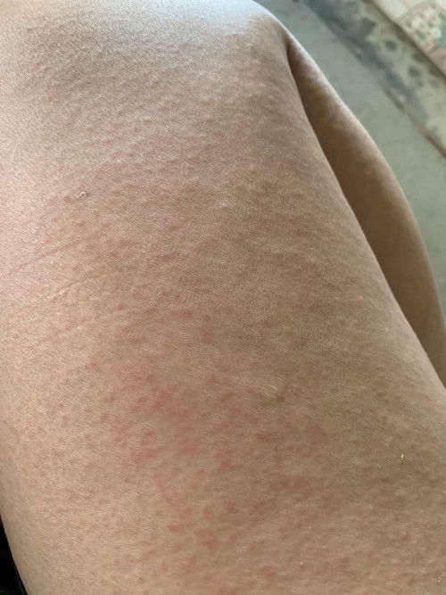 31วีคแล้ว ผื่นขึ้น