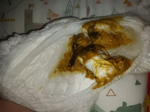 น้องอึแบบนี้คืออะไรค่ะปกติมั้ย