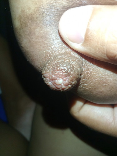 ปวดเต้านมมาก