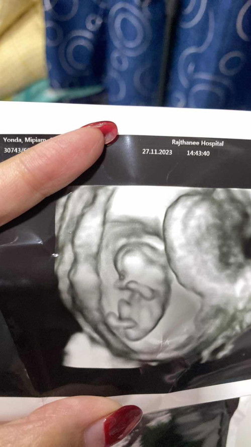 เจอถุงน้ำที่คอทารก ตอน 10 สัปดาห์