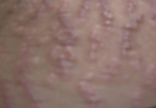 Stretchmark diperut gatal selepas bersalin