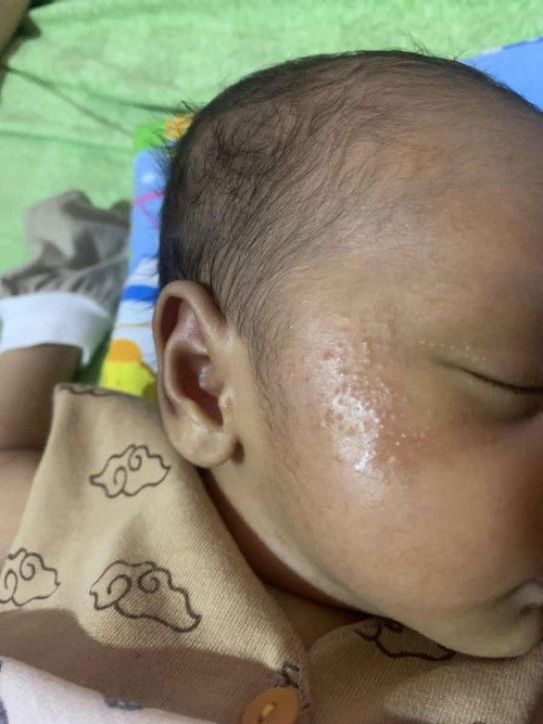 Ruam pada newborn
