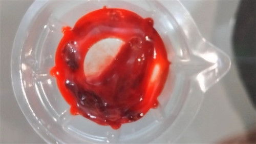 Miscarriage or blood clot?