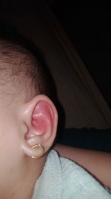 Telinga bayi bengkak dan merah