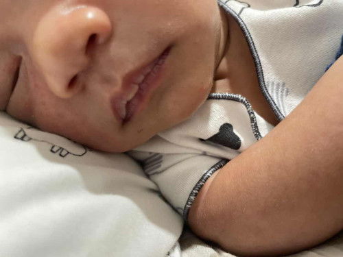 Lip Blister Pada Newborn