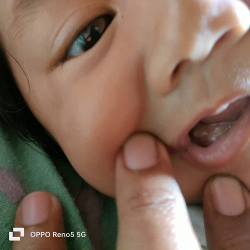 Ank umur 5 bln tp ada keras seperti gigi di samping,,apakah ini gigi?