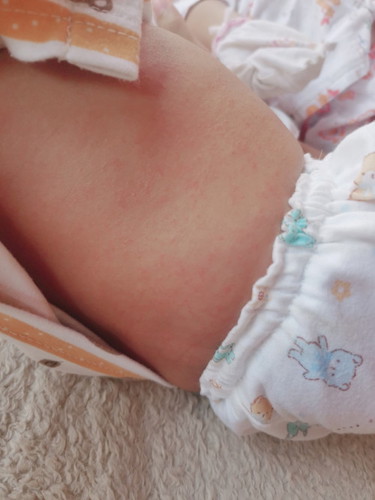 มีตุ่มแดงขึ้นตามตัว