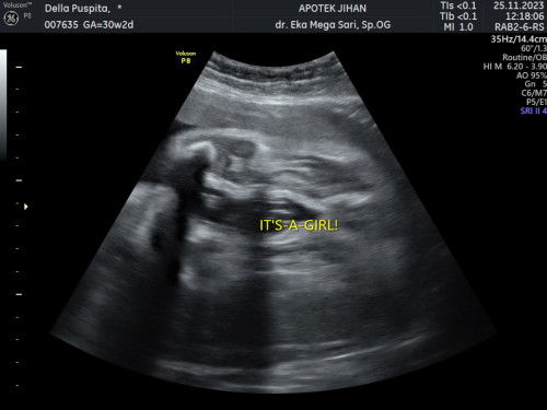 Usg jenis kelamin perempuan
