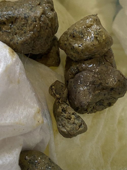 Hard green poop with black specks kay toddler