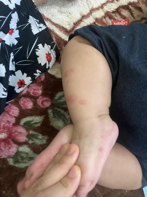 Bayi 6 bulan kena gigit serangga