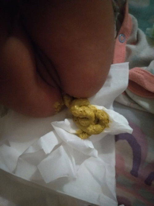 tekstur atau bentuk bab bayi umur hampir 2 bulan tidak pup 5 hari