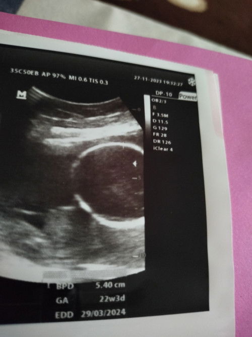 Mau tanya bunda bunda semua.. sdh saya cari juga istilah dalam USG knp yg ada cmn BPD, GA, sama EDD