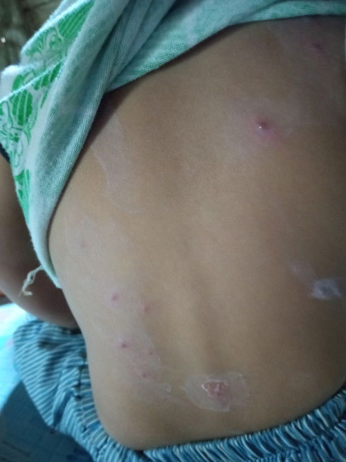 Cacar air anak 1 tahun