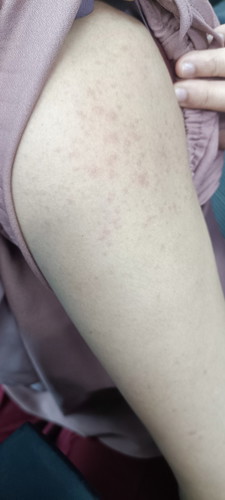 Batuk, trs demam panas dingin setelah demam di badan keluar ruam uap di badan, amankah hamil 20weeks