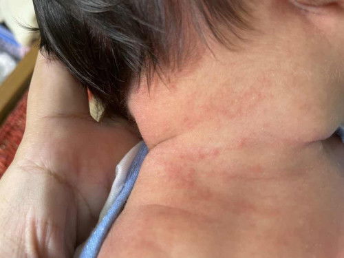 Da bé nổi như này là bị sao ạ