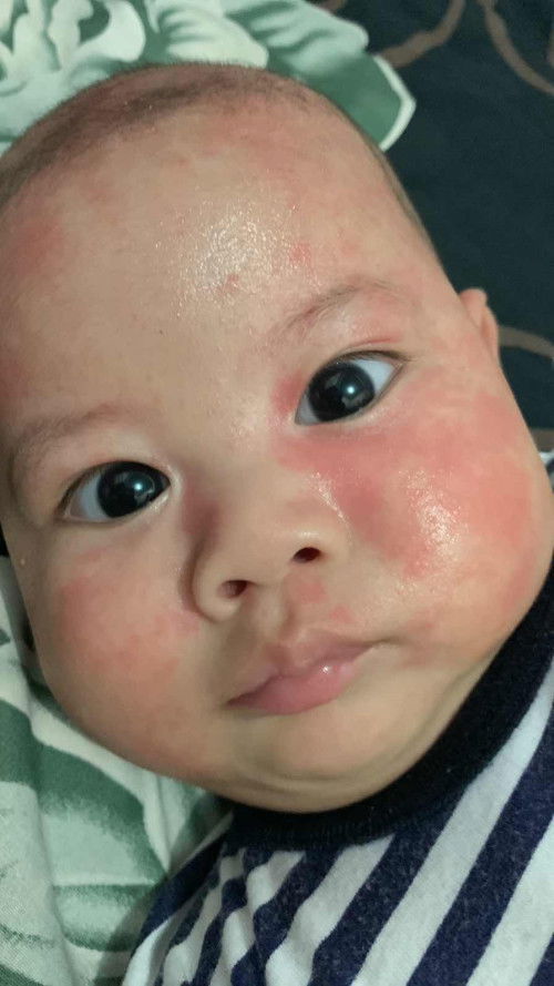 muka baby merah merah