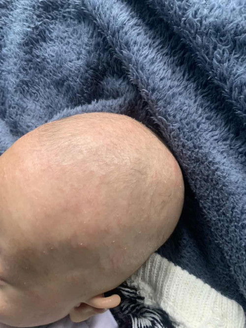 Bayi 3 bulan gatal seperti panu