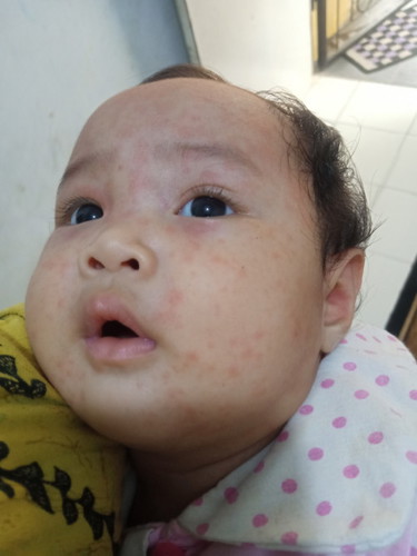Bintik merah di badan dan muka