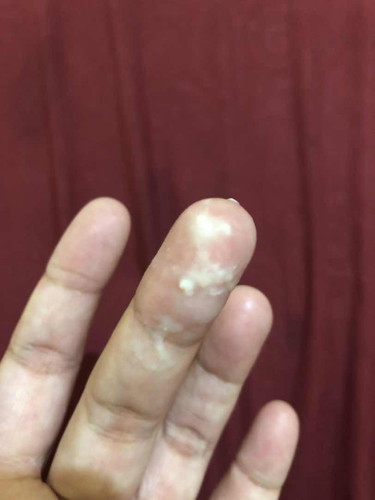 Keputihan seperti gumpalan susu