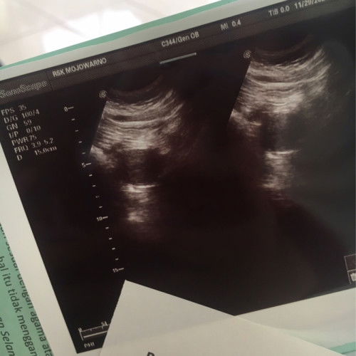 Keguguran hpht 18 oktober