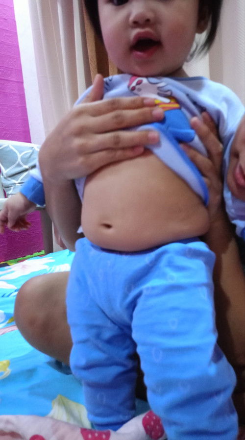 8 months baby normal.po ba ang tyan na ganito kay baby