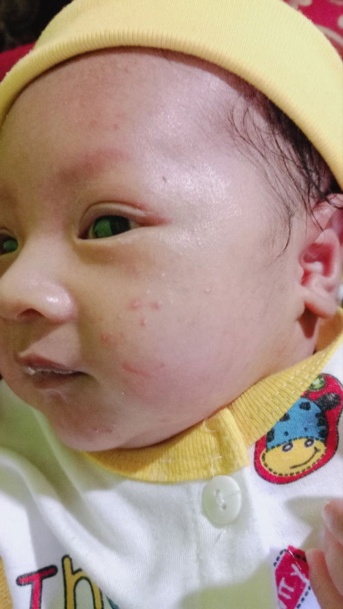 Bruntusan di wajah bayi