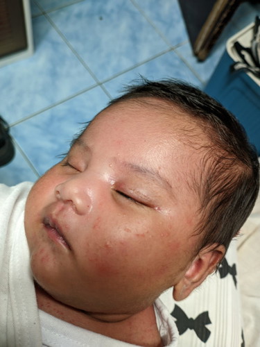 Rashes and Baby Acne