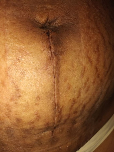 CS wound question