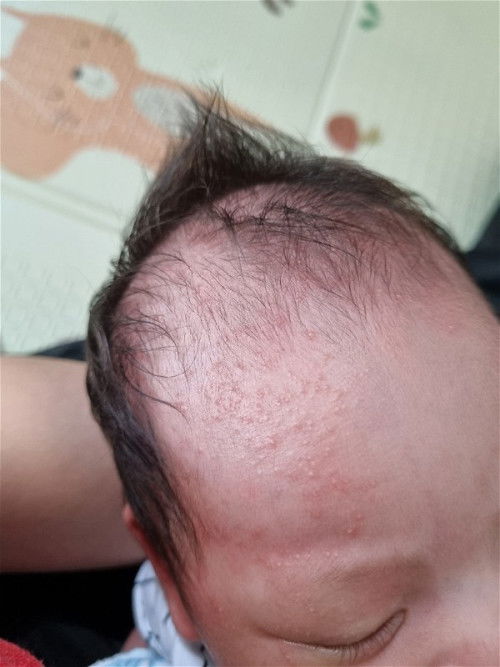 แพ้นม เนย ชีส