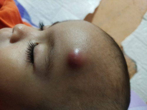 Bayi bisulan apa bukan ya??